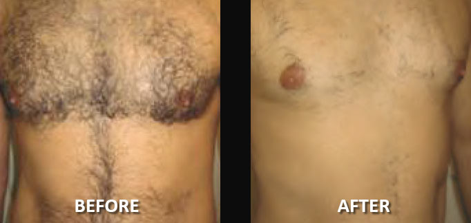 before-after-hair-removal-1
