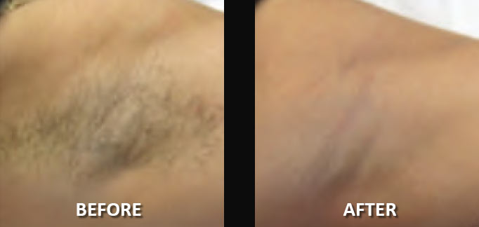 before-after-hair-removal-2