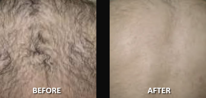 before-after-hair-removal-3