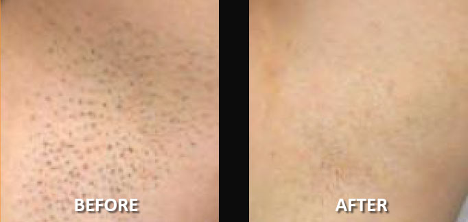 before-after-hair-removal-5