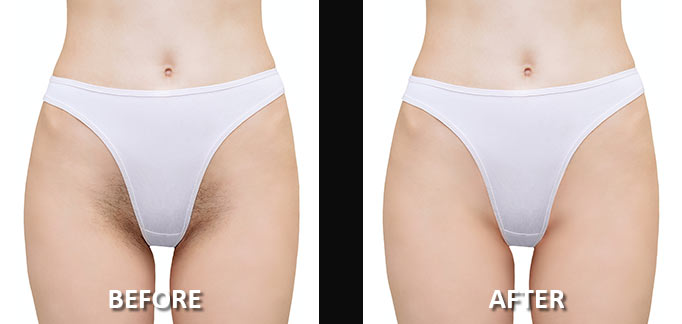 before-after-hair-removal-7