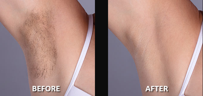 before-after-hair-removal-8